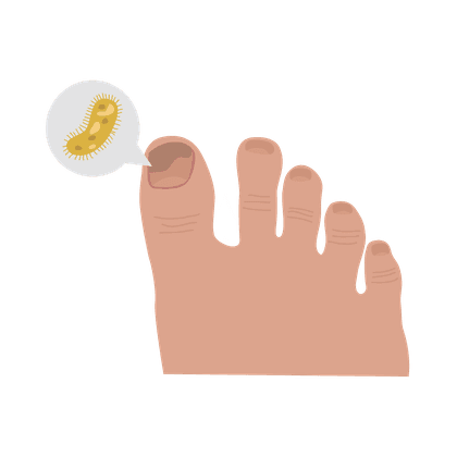 Jamur kuku (onikomikosis) dan jamur kaki (kutu air)