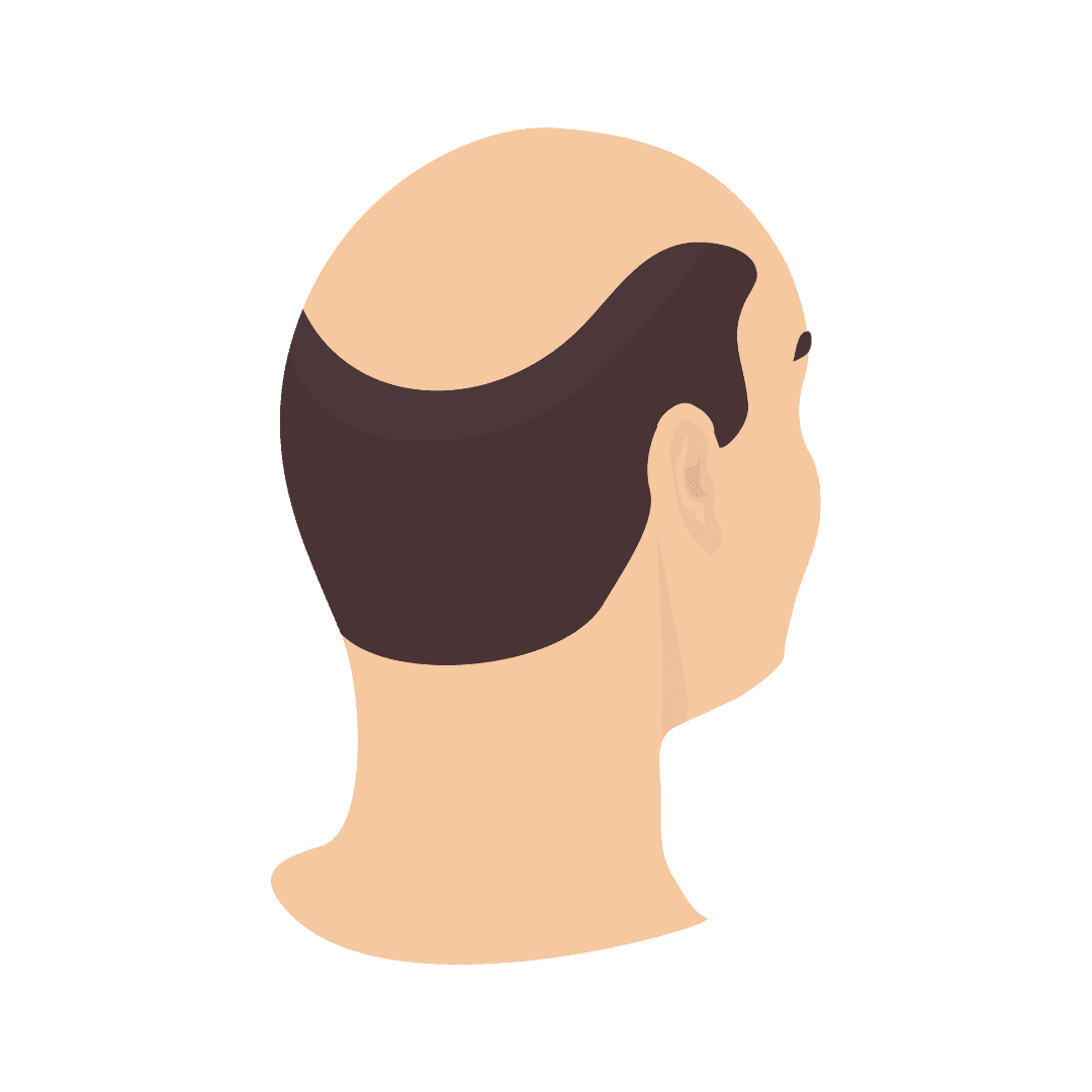 Alopecia (kebotakan, rambut rontok)