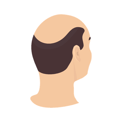 Alopecia (kebotakan, rambut rontok)