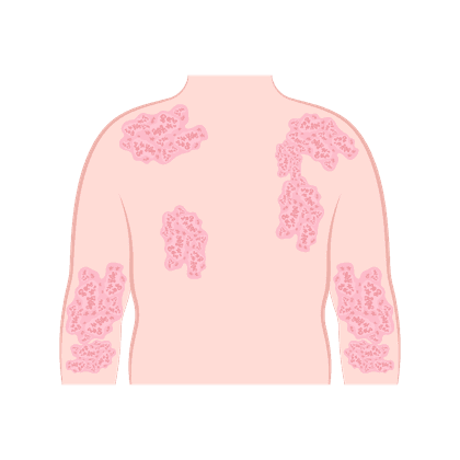 Dermatitis atopik, neurodermatitis