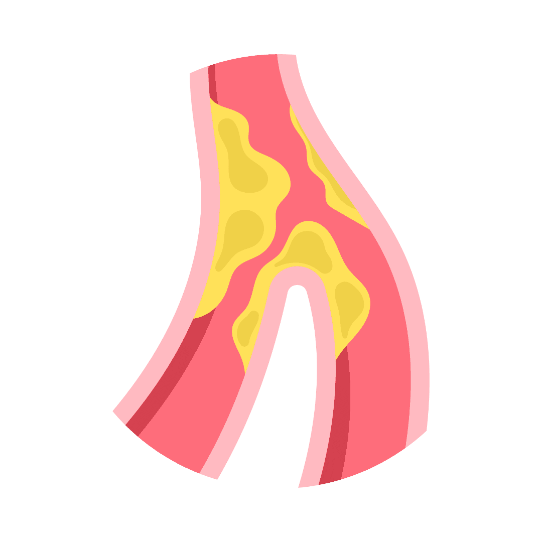 Aterosklerosis