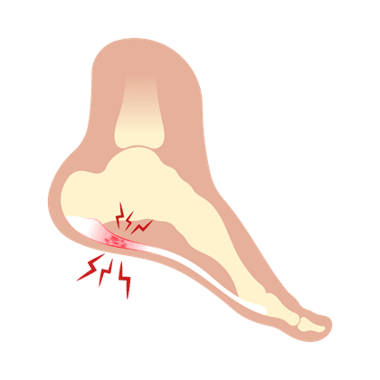 Taji tumit (osteofit)