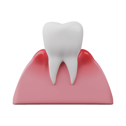 Peradangan gusi, radang gusi, periodontitis
