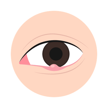 Jelai (hordeolum)