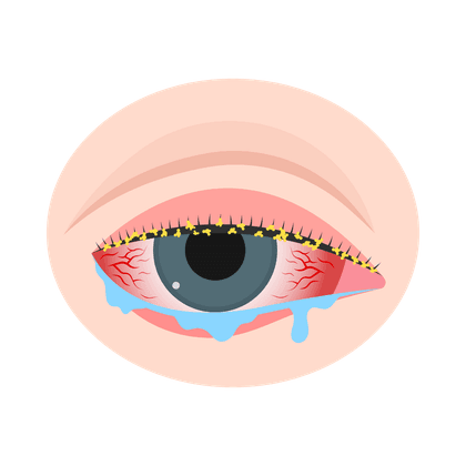 Konjungtivitis