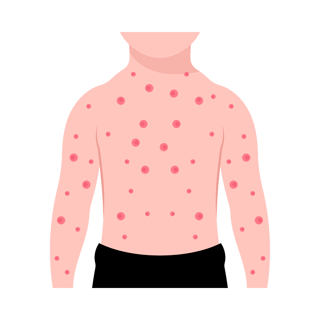 Cacar air (varicella)