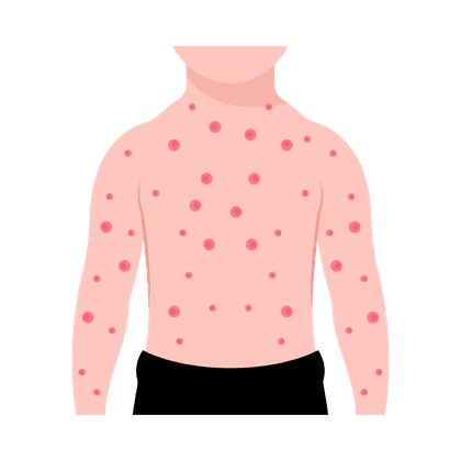Cacar air (varicella)